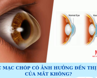 GIÁC MẠC CHÓP CÓ ẢNH HƯỞNG ĐẾN THỊ LỰC CỦA MẮT KHÔNG?